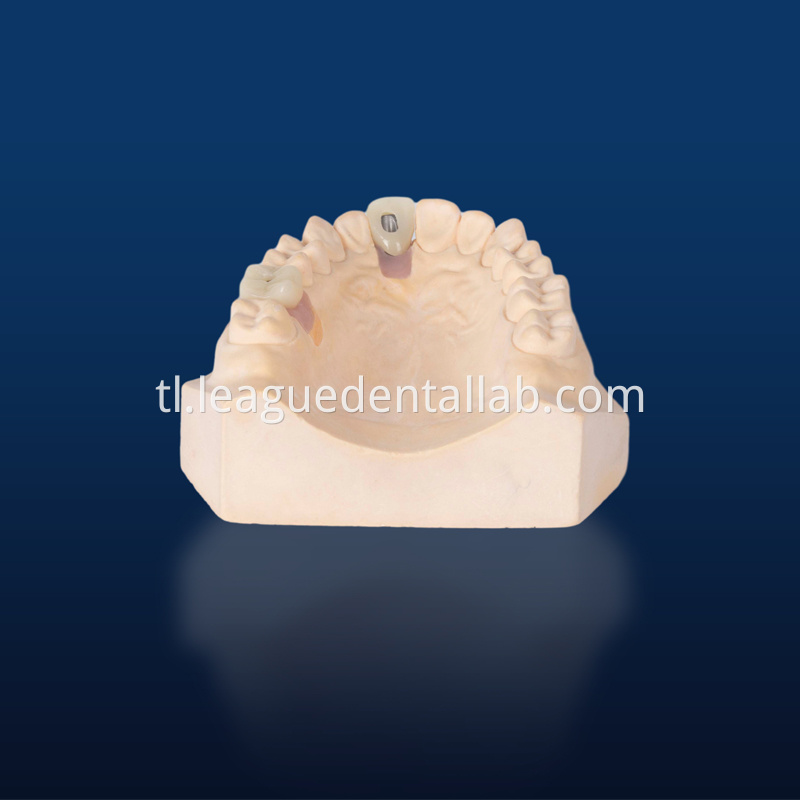 Dental Implant Crown, Dental Implant Zirconia crown,Dental Implant Emax crown,Dental Implant Bridge